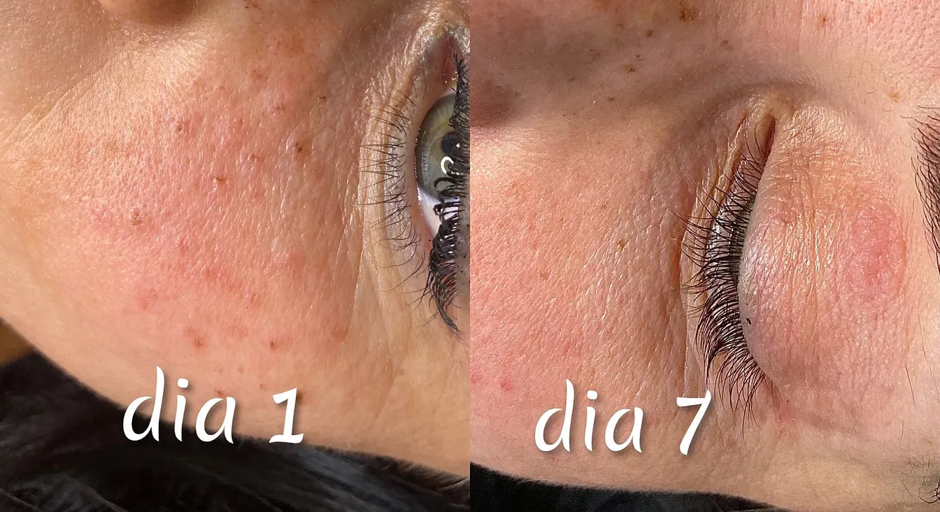 Pecas de freckling el día 1 y el día 7 de la curación